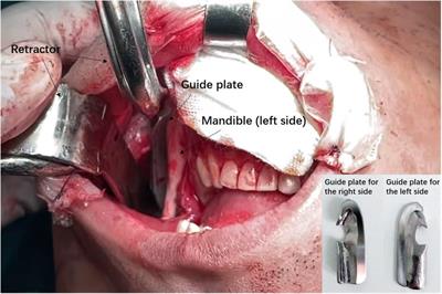 Correcting facial asymmetry through guided plate assisted mandibular angle osteotomy